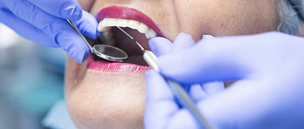 Best Knocked-Out Tooth (Avulsed Tooth) Treatment in Oakland, MO